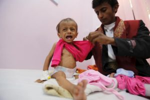 Man dresses his malnourished daughter at a malnutrition intensive care unit in Yemen's capital Sanaa