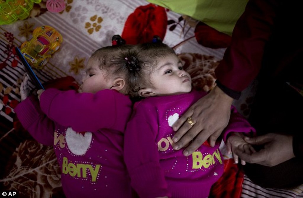 Conjoined Egyptian Twins Arrive at Riyadh for Treatment
