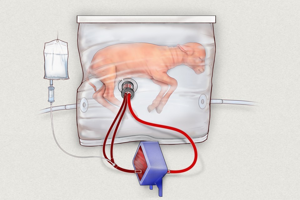 Artificial Womb to Incubate Premature Babies