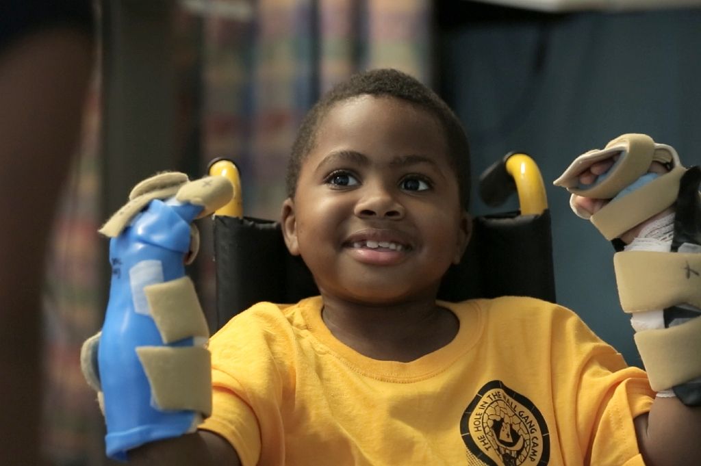 Doctors Confirm Success of World’s First Child Double Hand Transplant