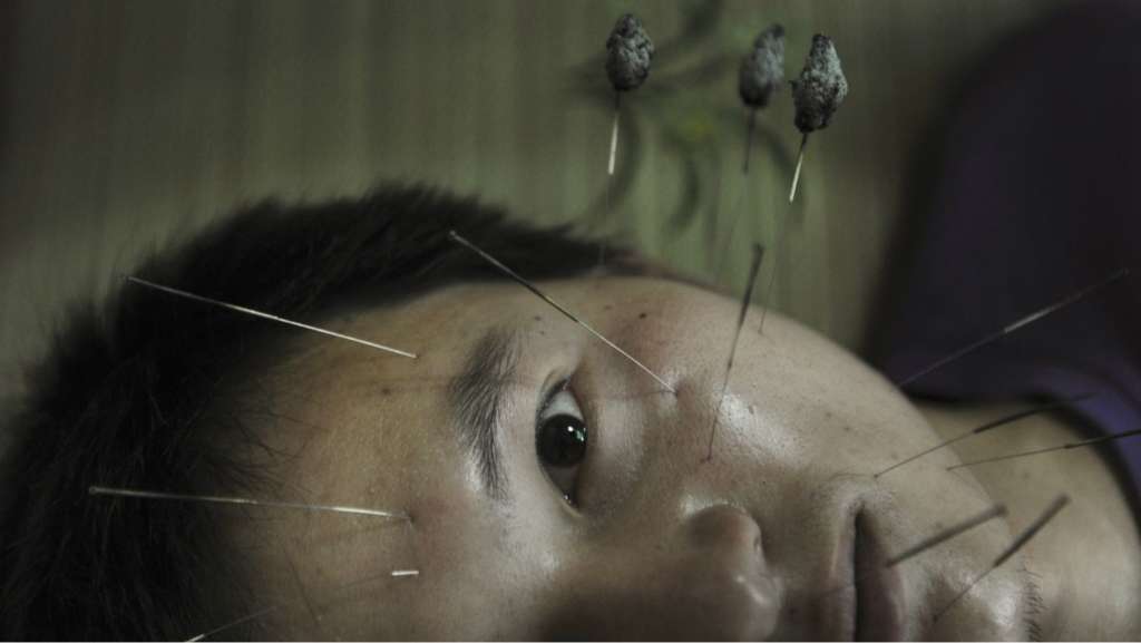Acupuncture…Another Option to Alleviate Pain